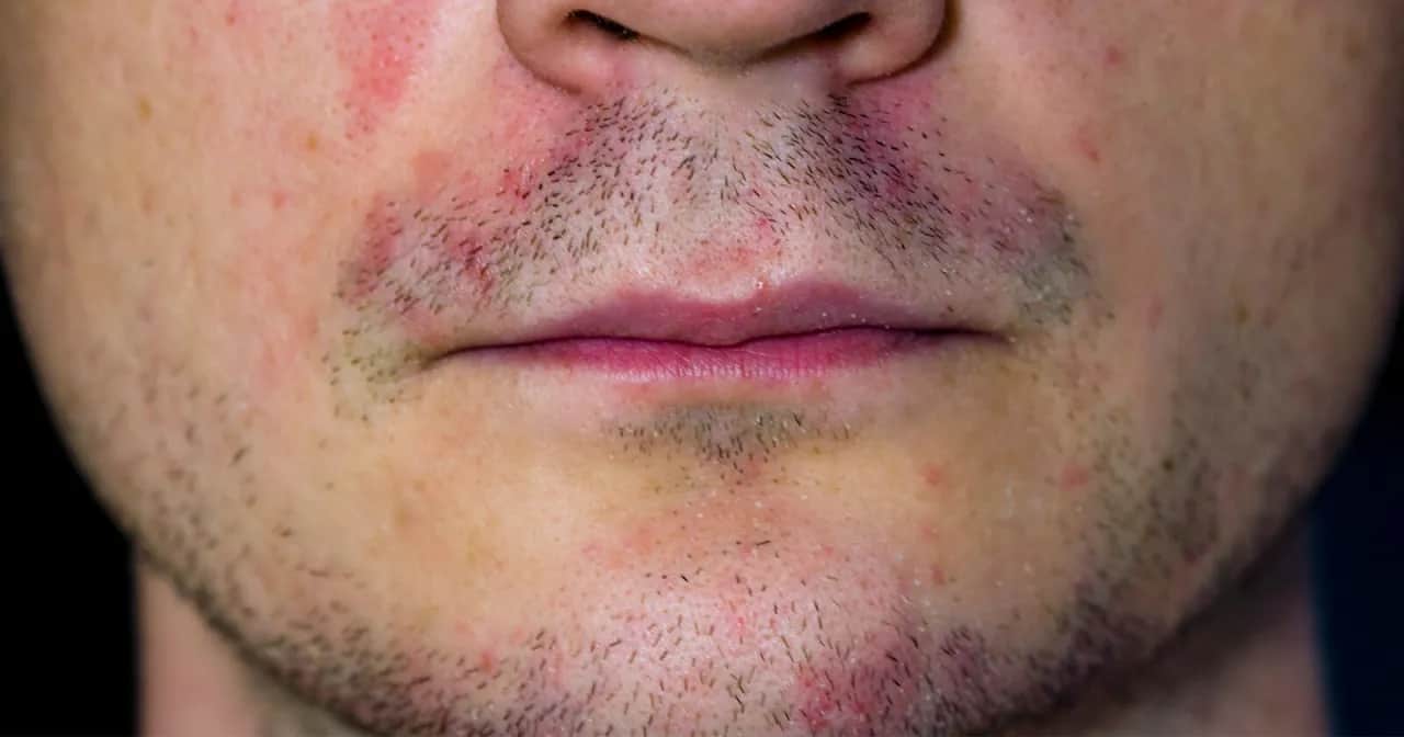 Gesichtshaut trocken & gerötet? So beruhigen Sie sie!