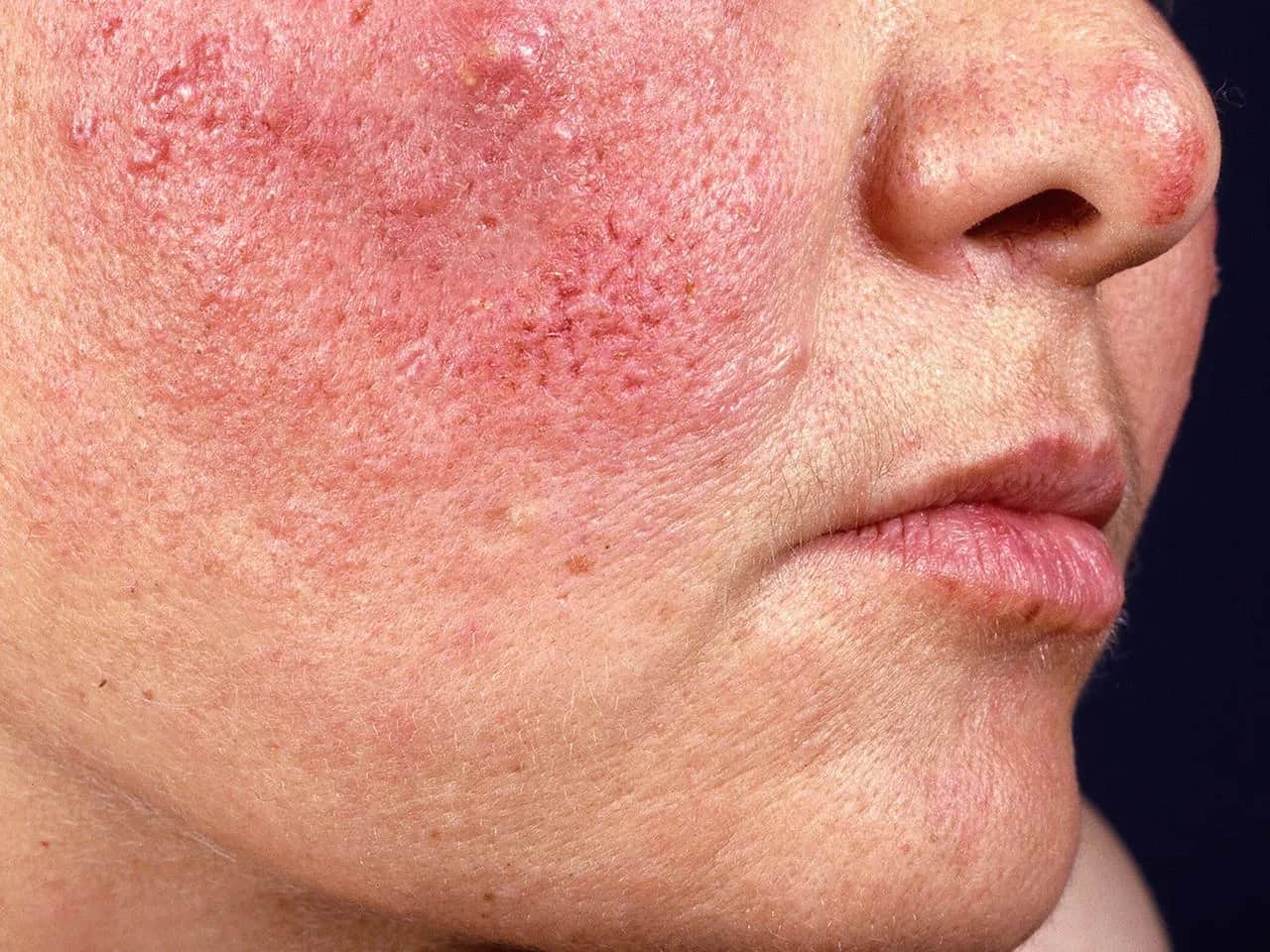 Warum ist mein Gesicht rot? Ursachen & Lösungen für gerötete Haut