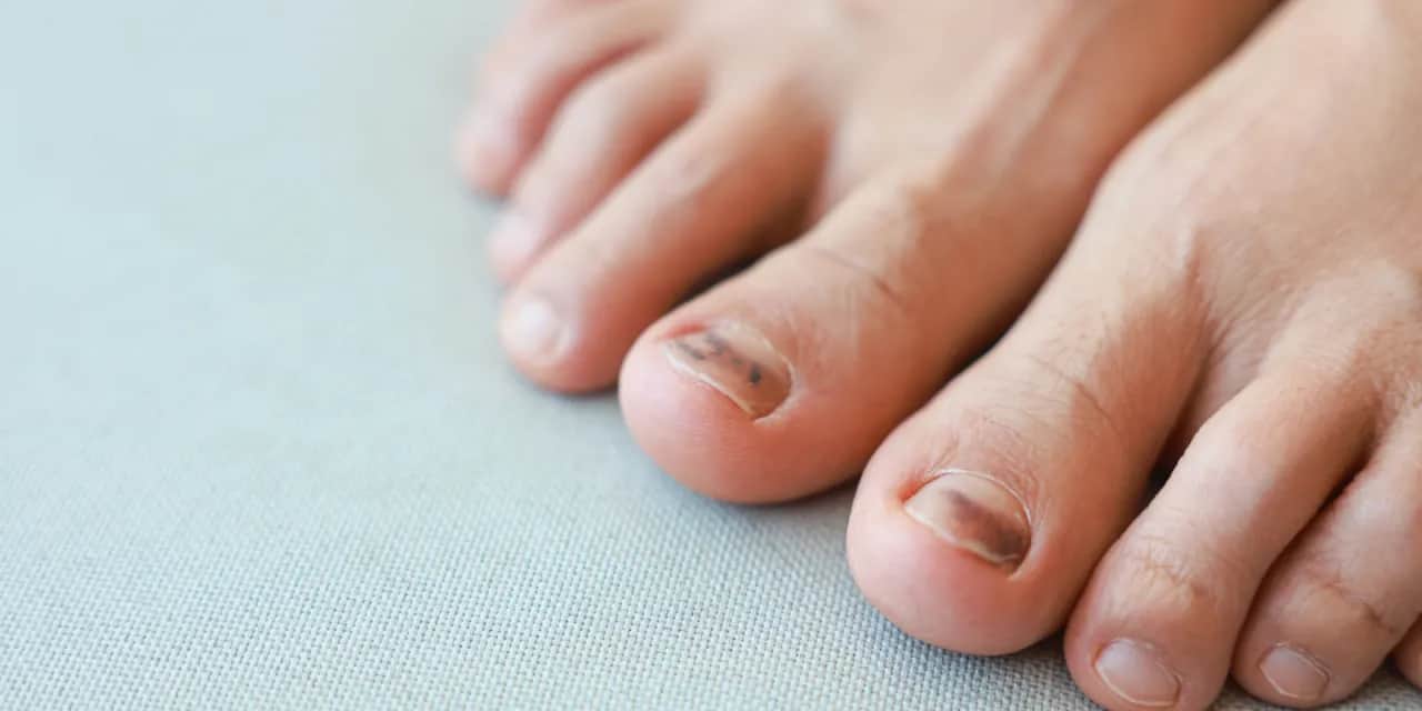 Blaue Nägel: Harmlos oder Warnsignal? Ursachen & wann zum Arzt