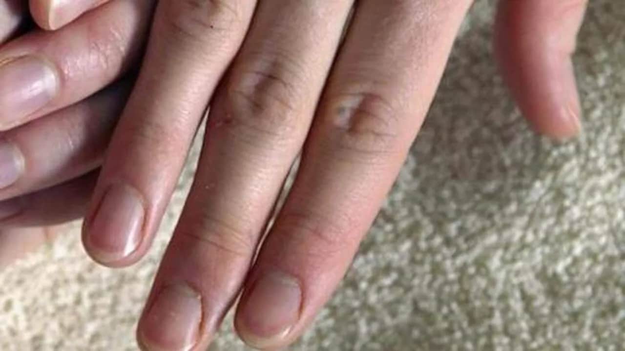 Weiße Flecken auf Nägeln: Mangel oder harmloser Stoß? Die Wahrheit