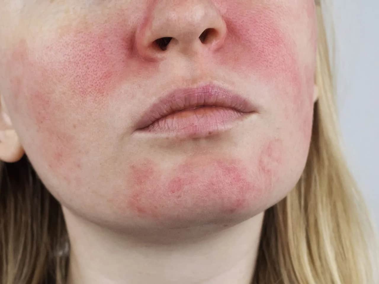 Schuppige & gerötete Haut: Ist es Rosacea? Ursachen & Lösungen